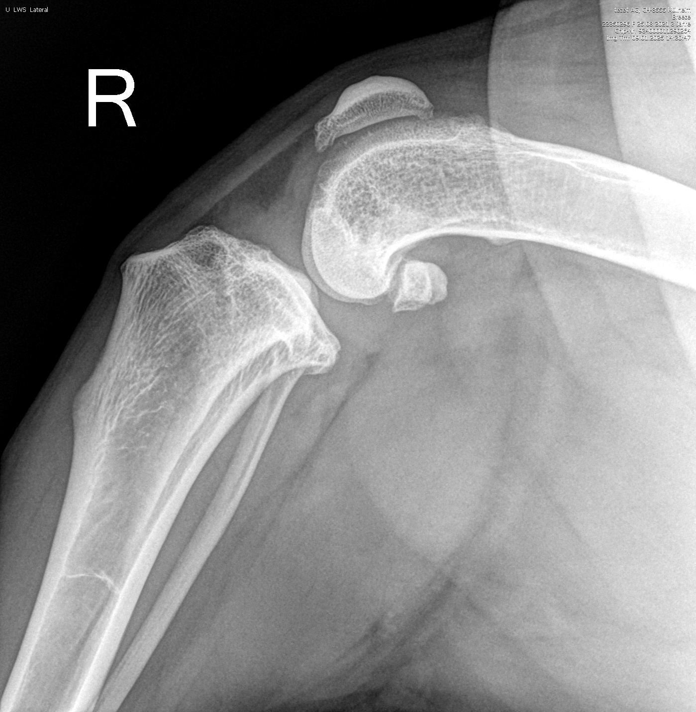 Webinar Interpretation Röntgenbilder: Kniegelenk